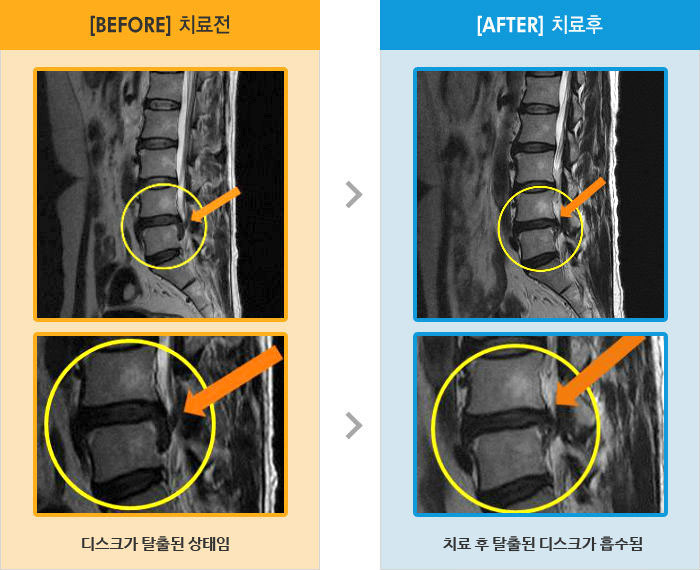 자생한방병원 치료사례 MRI로 보는 치료결과-걷거나 앉아 있다 일어날때 왼쪽 다리 통증