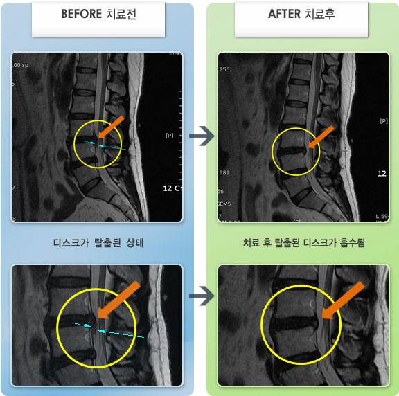 자생한방병원 치료사례 MRI로 보는 치료결과-오른쪽 다리 옆으로 당기고 저림