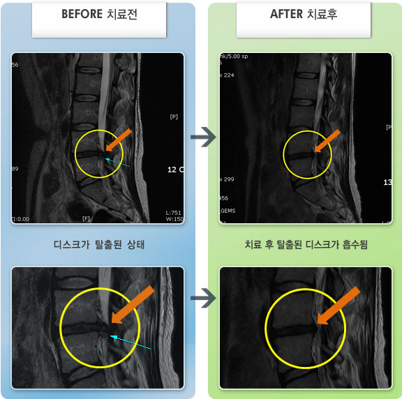 자생한방병원 치료사례 MRI로 보는 치료결과-좌측의 허리 통증과 심한 하지통증