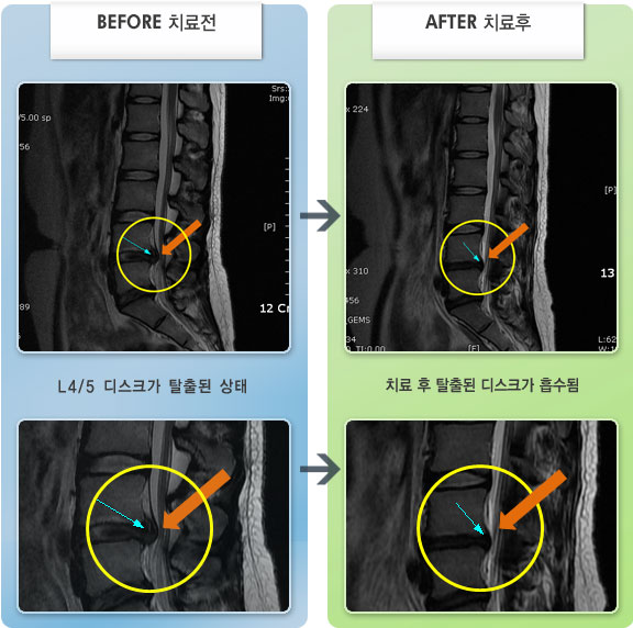 자생한방병원 치료사례 MRI로 보는 치료결과-누웠다 일어나기 힘들고 허리에서 양측 엉치로 통증이 심한 상태