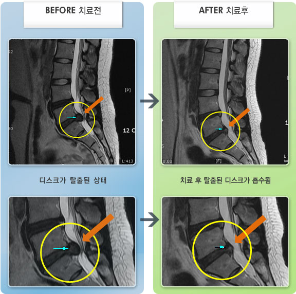 자생한방병원 치료사례 MRI로 보는 치료결과-엉덩이 부위에 극심한 통증과 다리에 심한 저림 당김 증상으로 움직임 및 거동이 불가한 상태
