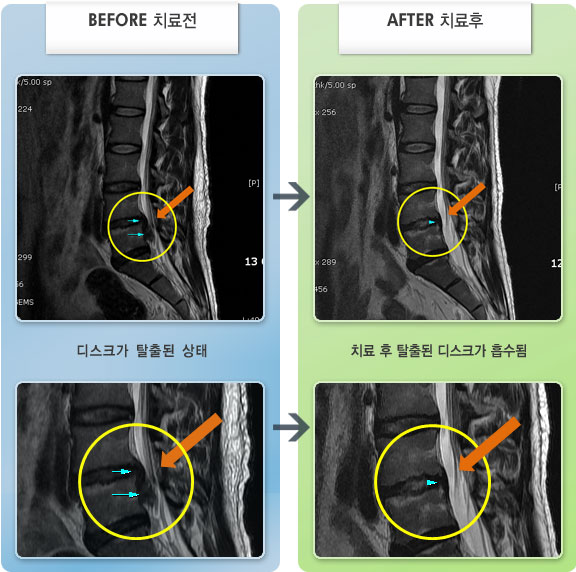 자생한방병원 치료사례 MRI로 보는 치료결과-보행 및 좌위시 허리 통증