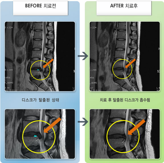 자생한방병원 치료사례 MRI로 보는 치료결과-좌측 허리, 엉덩이 부위에 극심한 통증