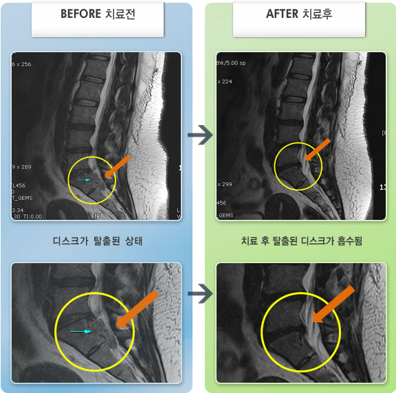 자생한방병원 치료사례 MRI로 보는 치료결과-허리의 통증 및 좌측 다리의 저림으로 보행이 불편한 상태