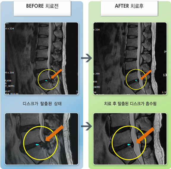 자생한방병원 치료사례 MRI로 보는 치료결과-허리 주위로 심한 통증과 좌측 엉치 및 다리가 저리면서 발에 이상 감각 증상