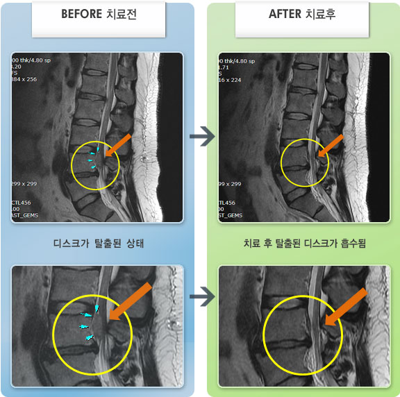 자생한방병원 치료사례 MRI로 보는 치료결과-2011년 4월 이유없이 우측 하지 통증과 저림이 생겼다.