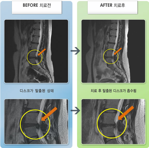 자생한방병원 치료사례 MRI로 보는 치료결과-수면시 통증이 심하여 잠을 잘 잘수가 없었다.
