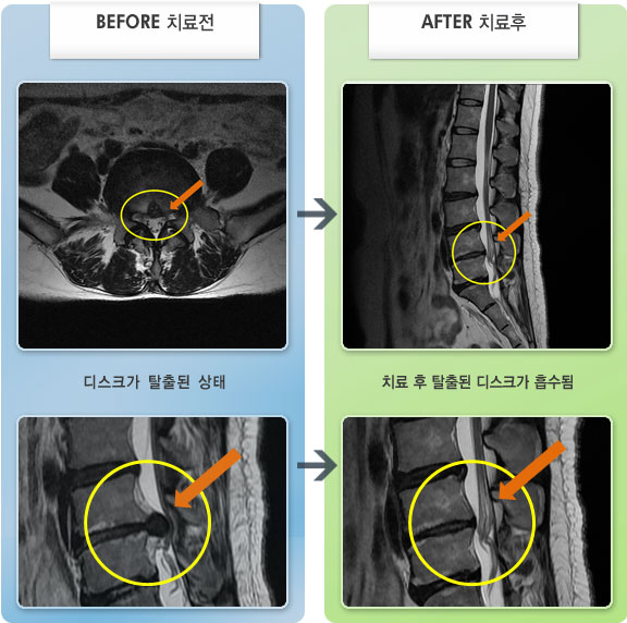 자생한방병원 치료사례 MRI로 보는 치료결과-요통과 양측 하지통으로 보행이 불가하고, 똑바로 서기 힘든 상태