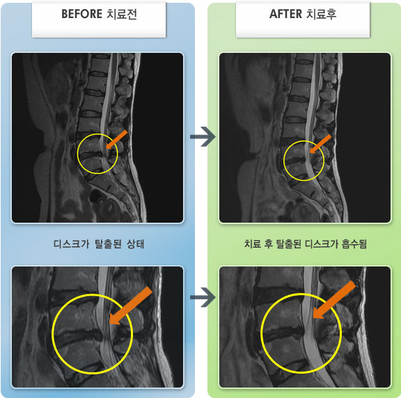 자생한방병원 치료사례 MRI로 보는 치료결과-좌측 하지 방사통이 심하여 수면이 어려운 상태
