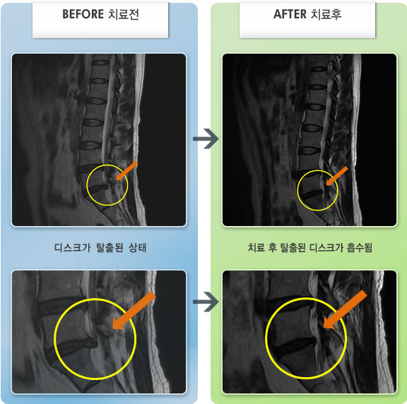 자생한방병원 치료사례 MRI로 보는 치료결과-허리를 숙이거나 젖히기가 불편하고, 좌측 골반부 통증 및 방사통이 있었다.