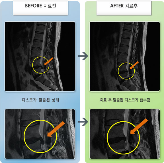 자생한방병원 치료사례 MRI로 보는 치료결과-아침에 일어날때 통증이 심하고 앉아있기 힘들었다. 