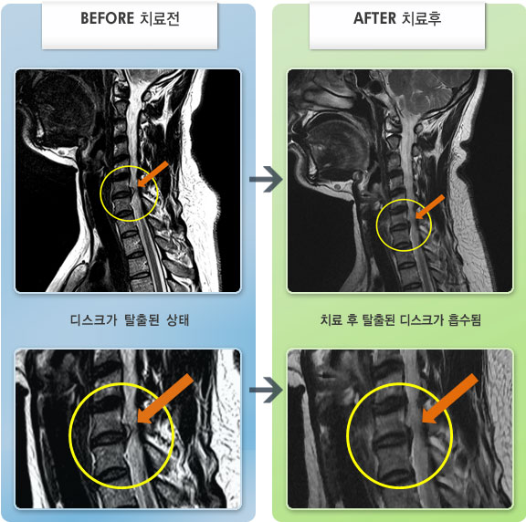 자생한방병원 치료사례 MRI로 보는 치료결과-후경부 통증과 양측 어깨, 상완 통증 , 양측 견갑부위 통증과 간헐적으로 우측 손끝 저림