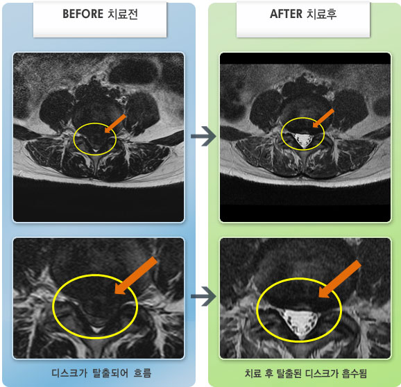 자생한방병원 치료사례 MRI로 보는 치료결과-허리의 통증이 지속되고 양측 종아리 발바닥 저림으로 일상생활이 어려운 상태
