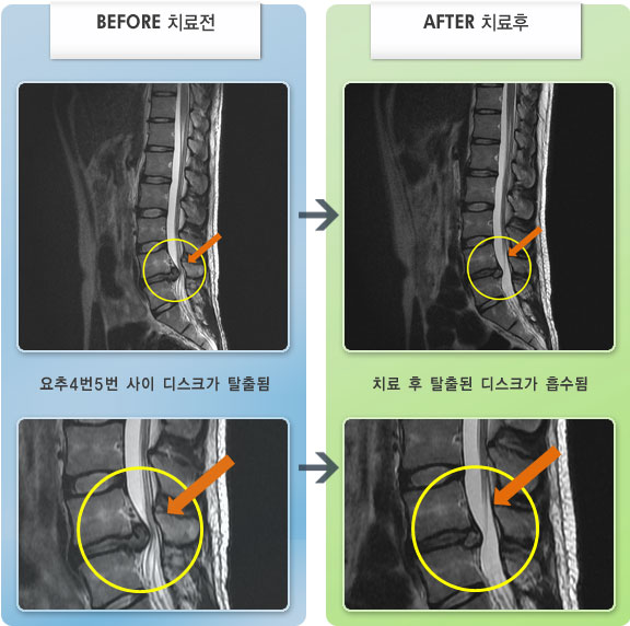 자생한방병원 치료사례 MRI로 보는 치료결과-걸을때 양쪽 엉치 통증이 심하고 좌측 엉치에서 발목으로 방산통이 심한 상태
