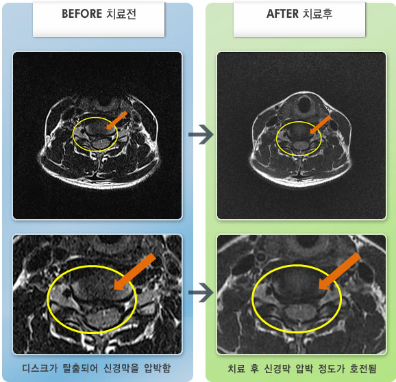 자생한방병원 치료사례 MRI로 보는 치료결과-뒷목 통증과 우측 상박부 저림
