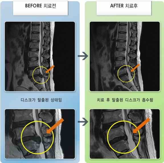 자생한방병원 치료사례 MRI로 보는 치료결과-허리 통증과 좌측 다리 통증으로 걷기가 힘든 상태