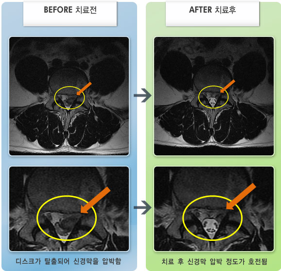 자생한방병원 치료사례 MRI로 보는 치료결과-등산 후 갑자기 허리 통증과 좌측 다리 저림이 심해졌다.