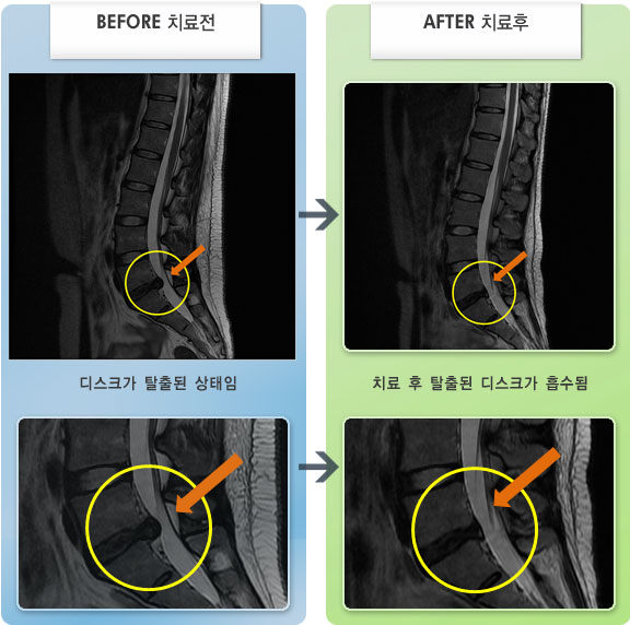 자생한방병원 치료사례 MRI로 보는 치료결과-허리 구부리기도 힘들고 저림으로 수면이 어려운 상태