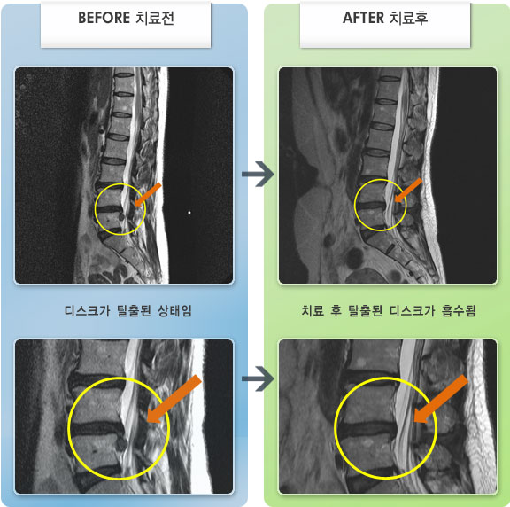자생한방병원 치료사례 MRI로 보는 치료결과-허리 통증과 오른쪽 다리 저림