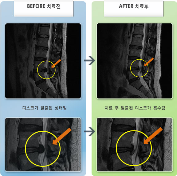 자생한방병원 치료사례 MRI로 보는 치료결과-농구하다가 다친 이후로 허리통증이 극심하고 보행이 힘든 상태