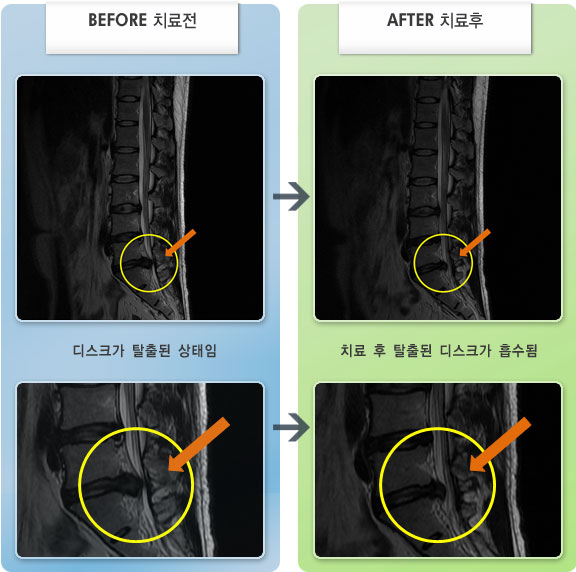 자생한방병원 치료사례 MRI로 보는 치료결과-좌측 대퇴부 후면으로 저림 증상과 요통으로 일상생활이 힘든 상태