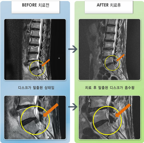 자생한방병원 치료사례 MRI로 보는 치료결과-허리와 다리 통증으로 걷기 힘들어서 입원치료를 하였다.