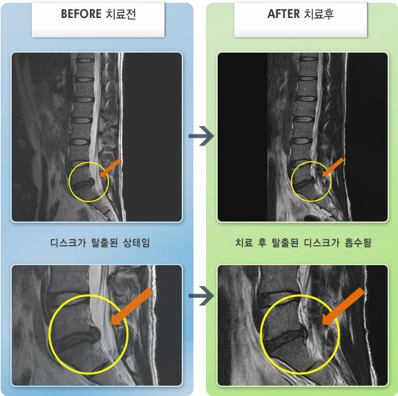 자생한방병원 치료사례 MRI로 보는 치료결과-허리디스크로 인한 다리저림