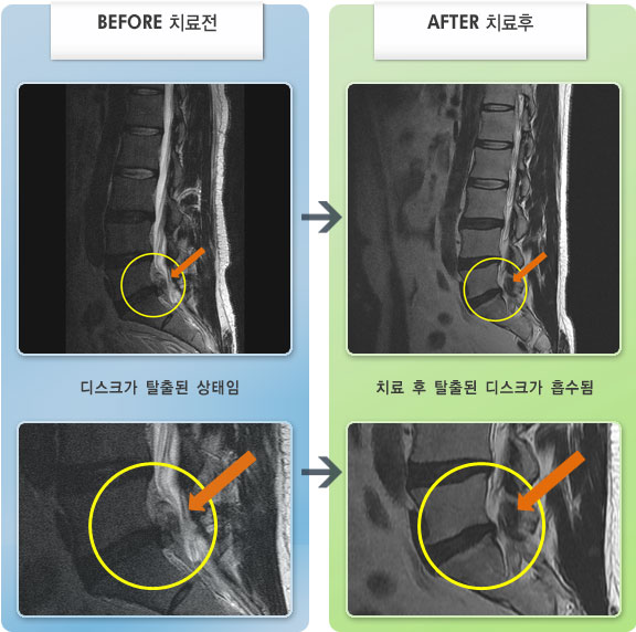 자생한방병원 치료사례 MRI로 보는 치료결과-걸을때는 쑤시고 허리를 젖히면 통증이 심하였다.