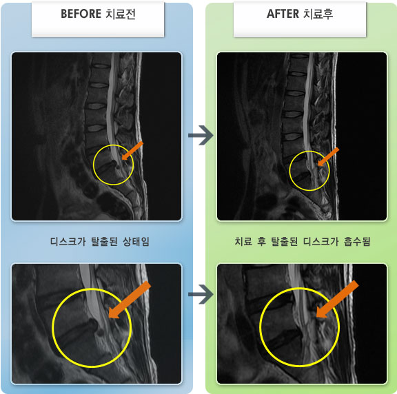 자생한방병원 치료사례 MRI로 보는 치료결과-허리디스크로 인한 허리 통증 및 다리저림