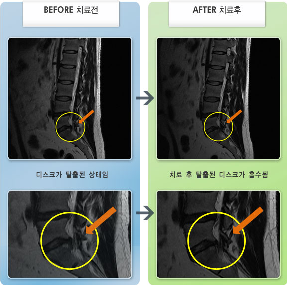 자생한방병원 치료사례 MRI로 보는 치료결과-허리디스크로 인한 우측 다리저림