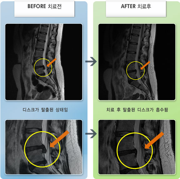 자생한방병원 치료사례 MRI로 보는 치료결과-허리디스크로 인한 좌측 허리 및 엉치 통증