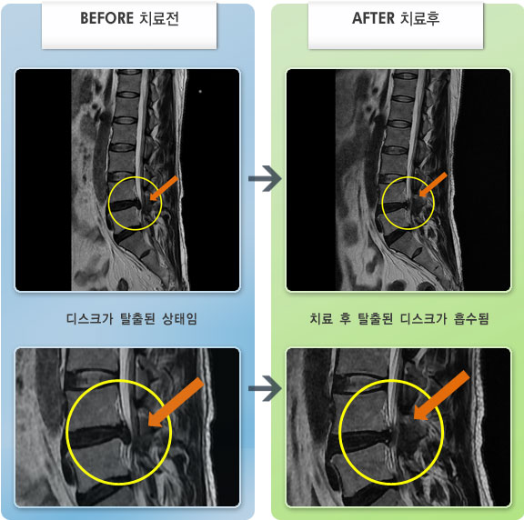 자생한방병원 치료사례 MRI로 보는 치료결과-허리디스크로 인한 왼쪽 발 저림