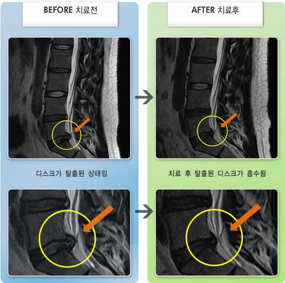 자생한방병원 치료사례 MRI로 보는 치료결과-허리디스크로 인한 좌측 하퇴부 저림 증세