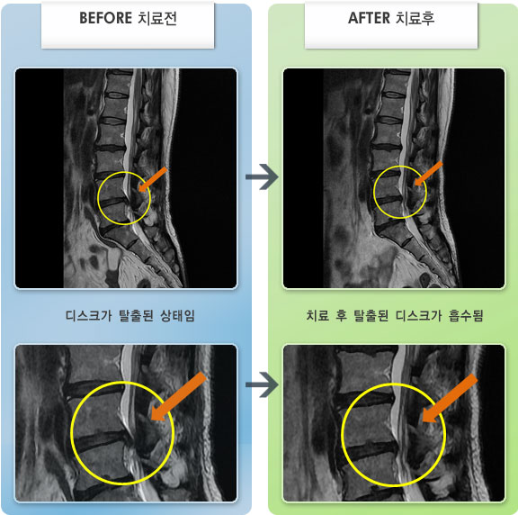 자생한방병원 치료사례 MRI로 보는 치료결과-허리디스크로 인한 우측 요부, 둔부, 대퇴부 저림