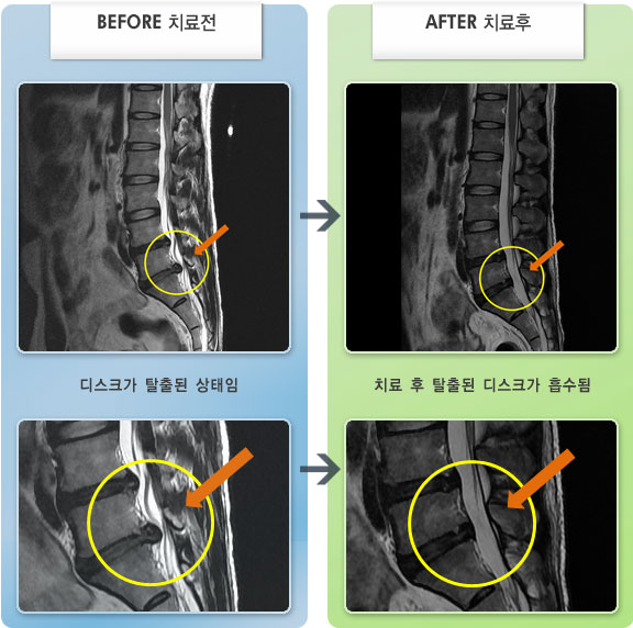 자생한방병원 치료사례 MRI로 보는 치료결과-허리디스크로 인한 오른쪽 허벅지 저림 증세