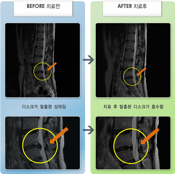 자생한방병원 치료사례 MRI로 보는 치료결과-허리디스크로 인한 허리 통증 및 대퇴부 저림 증세
