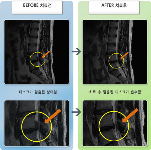자생한방병원 치료사례 MRI로 보는 치료결과-허리디스크로 인한 우측 무릎 저림 증세