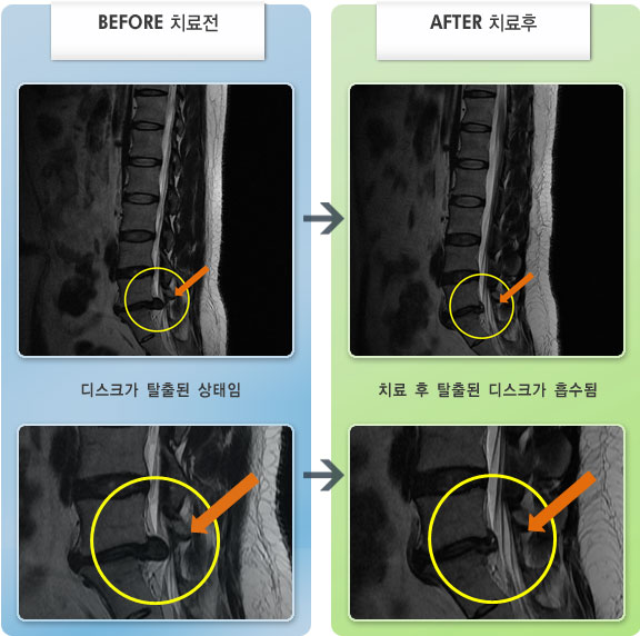 자생한방병원 치료사례 MRI로 보는 치료결과-허리디스크로 인한 우측 하지 통증