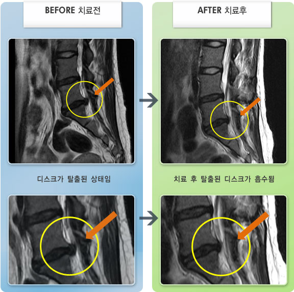 자생한방병원 치료사례 MRI로 보는 치료결과-허리디스크로 인한 우측 종아리 통증