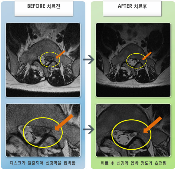 자생한방병원 치료사례 MRI로 보는 치료결과-허리디스크로 인한 다리 통증