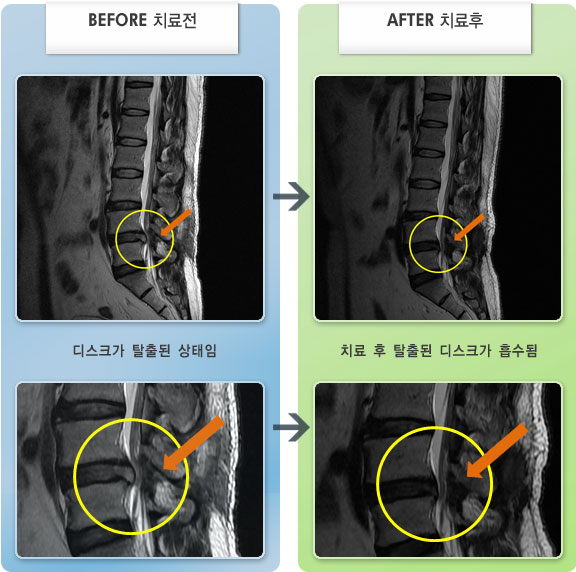자생한방병원 치료사례 MRI로 보는 치료결과-우측 둔부에서 종아리 측면으로 심한 통증이 있었다.