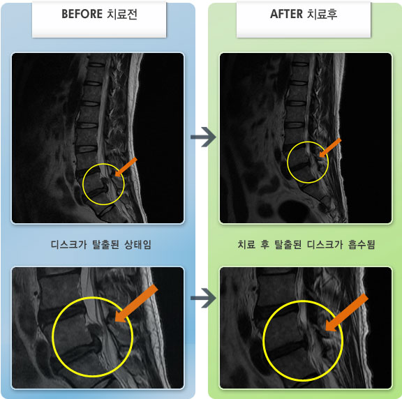 자생한방병원 치료사례 MRI로 보는 치료결과-허리디스크로 인한 좌측 종아리, 엄지 발가락 저림증상