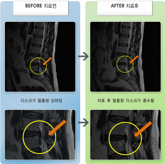 자생한방병원 치료사례 MRI로 보는 치료결과-허리통증과 엉치에서 오른쪽 발등, 발바닥까지 찌릿함이 있었다. 