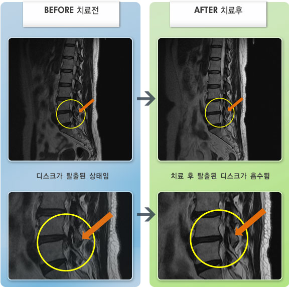 자생한방병원 치료사례 MRI로 보는 치료결과-허리 통증과 왼쪽 다리 뒤쪽으로 저림 있고 엄지발가락, 발바닥까지 저림이 있었다. 