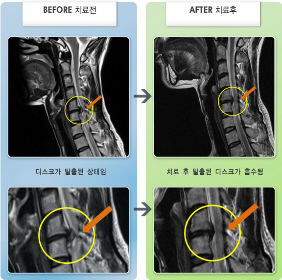 자생한방병원 치료사례 MRI로 보는 치료결과-목디스크로 인한 두통