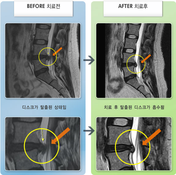 자생한방병원 치료사례 MRI로 보는 치료결과-허리 통증이 심하고 다리 저림이 심하였다.