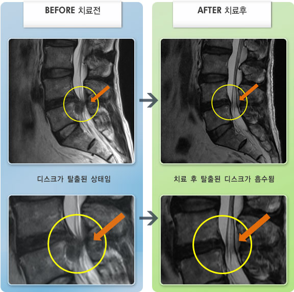 자생한방병원 치료사례 MRI로 보는 치료결과-허리디스크로 인한 허리 및 종아리 통증