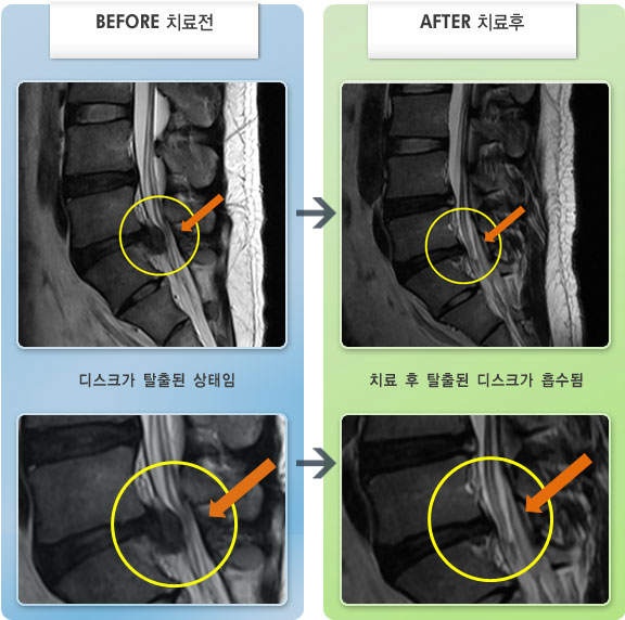자생한방병원 치료사례 MRI로 보는 치료결과-허리 통증과 우측 엉덩이 및 다리저림 증상