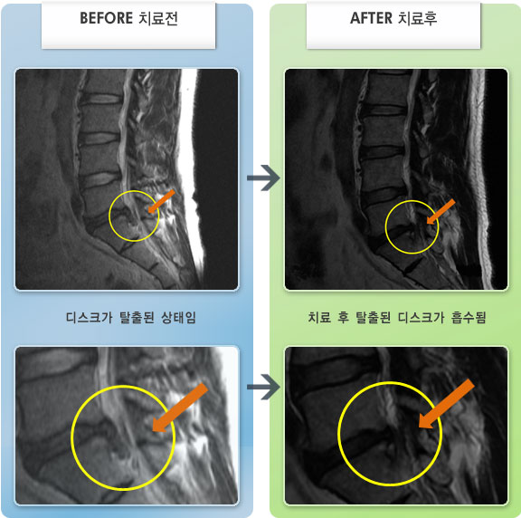 자생한방병원 치료사례 MRI로 보는 치료결과-허리통증 및 좌측 다리 저림 증상