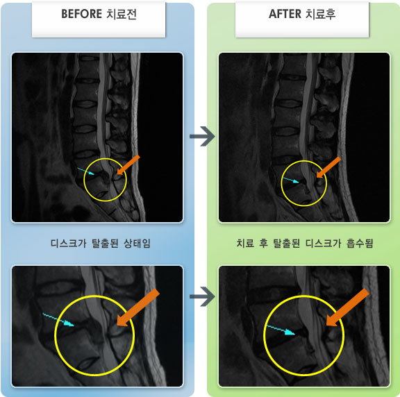 자생한방병원 치료사례 MRI로 보는 치료결과-요통 및 좌하지 방사통, 좌하지 무력감